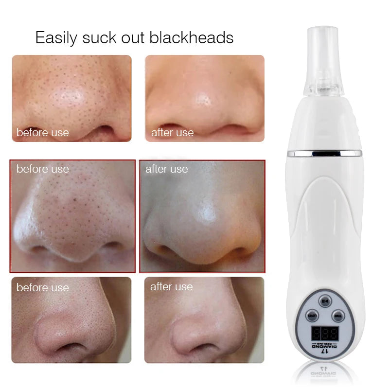 Diamond Microdermabrasion Machine – At-Home Facial Skin Resurfacing Device